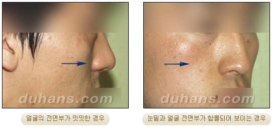 [두한성형외과 얼굴자가지방이식] - [귀족수술 입체 미세지방이식] 관련 이미지 2