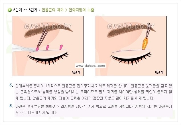 [두한성형외과 경쟁력 눈성형] - [퀵쌍꺼풀 수술] 관련 이미지 4