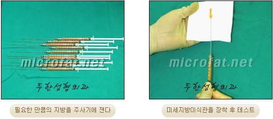 이마성형 두한성형외과 - 이마주름, 이마지방이식 관련 이미지 7