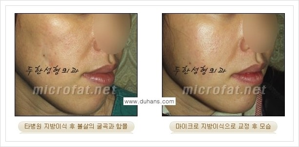 [두한성형외과 경쟁력 윤곽성형] - [볼, 볼살 지방이식] 관련 이미지 34