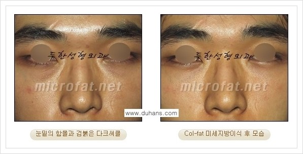 [두한성형외과 경쟁력 눈밑성형] - [눈밑 다크써클과 눈밑 함몰주름의 최적화 교정방법 안내] 관련 이미지 6