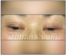 Candidates for Double Eyelid Revision Surgery: Unattractive Double Eyelids, Beautiful Double Eyelids image 17