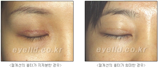 쌍커풀수술 두한성형외과 - 나에게 맞는 눈성형은? 관련 이미지 11