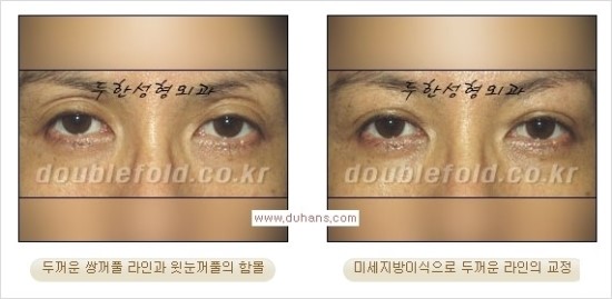 [두한성형외과 경쟁력 눈성형] - [쌍꺼풀 재수술 과정과 쌍꺼풀 재수술 실패의 원인, 쌍꺼풀 재수술의 성공 요건] 관련 이미지 39