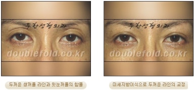 [Duhan Plastic Surgery Revision Double Eyelid Surgery] - [Double Eyelid Revision Surgery Process] image 36