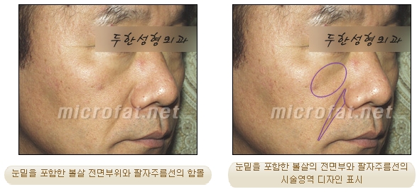 [Duhan Plastic Surgery Face Autologous Fat Grafting] - [Noble Surgery and Indian Band Fat Grafting] image 11