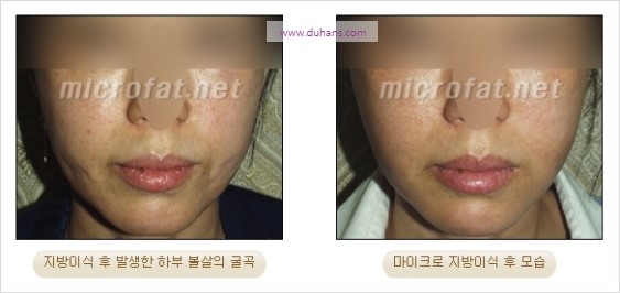 [두한성형외과 경쟁력 지방이식] - [두한 자가지방이식 클리닉 안내]​ 관련 이미지 82
