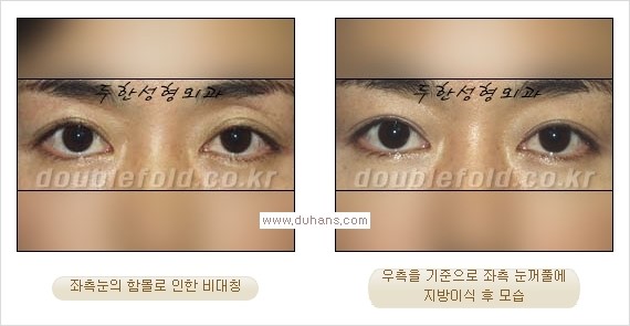 ​⁠⁠[두한성형외과 경쟁력 쌍꺼풀 재수술, 극한 눈재수술] - [지방이식으로 눈매와 쌍꺼풀 라인을 교정] 관련 이미지 13