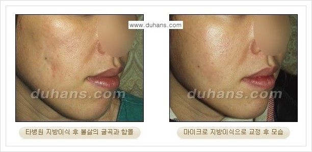 [두한성형외과 경쟁력 얼굴 미세지방이식] - [타병원에서 지방이식 후 굴곡과 과주입 교정 안내] 관련 이미지 5