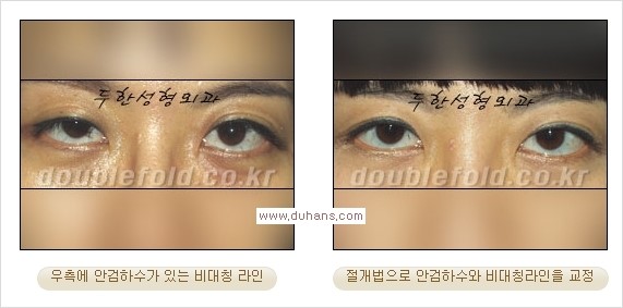 [두한성형외과 경쟁력 쌍꺼풀 재수술, 극한 눈재수술] - [안검하수 검사 및 수술방법 안내] 관련 이미지 15