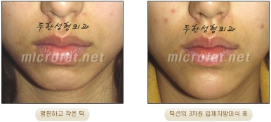 [Duhan Plastic Surgery Clinic Microgenia Correction] - [Chin Microfat Grafting] image 15