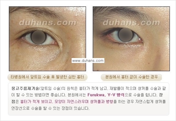 [두한성형외과 NO.1 눈성형] - [몽고주름 제거(앞트임 수술) 1.] 관련 이미지 8