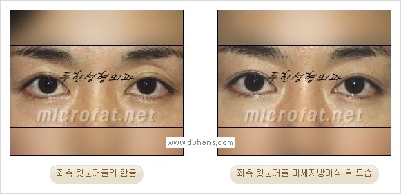[두한성형외과 경쟁력 미세지방이식] - [꺼진(함몰된) 윗눈꺼풀 미세지방이식] 관련 이미지 16