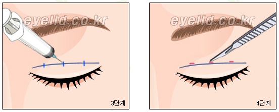 [Duhan Plastic Surgery Eye Surgery] - [First Double Eyelid Surgery] image 12