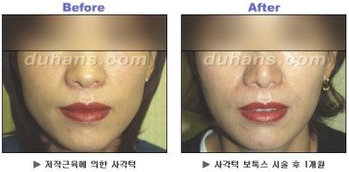 [Duhan Plastic Surgery Clinic Aesthetic Procedures] - [Square Jaw Botox] image 28