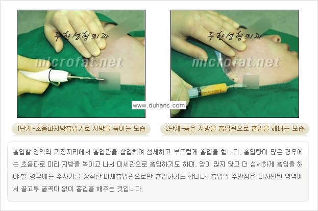 [두한성형외과 겨울엔 지방흡입을] - [통통한 볼살, 두툼한 턱선의 지방흡입 2.] 관련 이미지 4