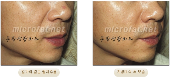 Wrinkle Improvement, Duhan Plastic Surgery - Mouth Lines, Nasolabial Folds image 23