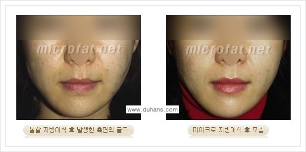 ​[두한성형외과 경쟁력 미세지방이식] - [타 병원에서 지방이식 후 발생한 굴곡현상 교정 방법 - 마이크로 지방이식] 관련 이미지 5