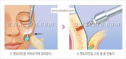 [두한성형외과 경쟁력 주름성형] - [주름제거와 볼륨을 갖게하는 엔도타인 리프팅] 관련 이미지 32