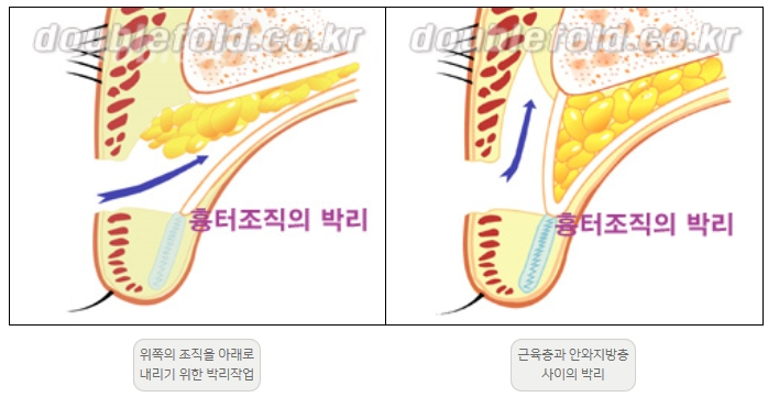 [Duhan Plastic Surgery Double Eyelid Revision] - [Thick Double Eyelid Line] image 7