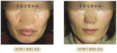 얼굴지방이식 두한성형외과 - 볼지방이식 관련 이미지 2