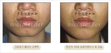 [두한성형외과 얼굴자가지방이식] - [지방이식 과정] 관련 이미지 50