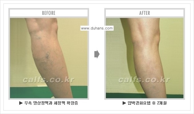 [두한성형외과 경쟁력 멀티종아리성형] - [하지정맥류 치료 안내] 관련 이미지 12