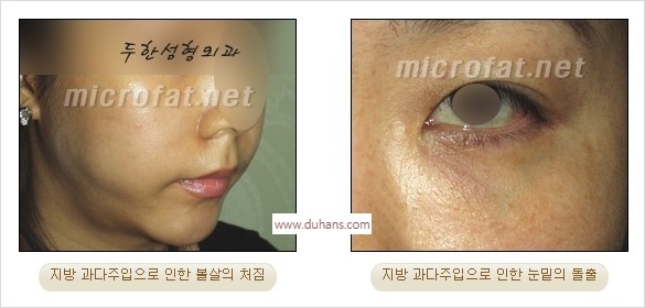[두한성형외과 경쟁력 미세지방이식] - [타 병원의 지방이식 부작용 교정 - 정교한 마이크로 지방이식, 흡입 안내] 관련 이미지 3