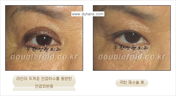 [두한성형외과 경쟁력 쌍꺼풀 재수술] - [망가진 쌍꺼풀 라인을 교정하는 극한재수술 ①] 관련 이미지 13