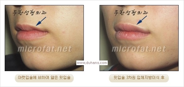[두한성형외과 경쟁력 미세지방이식] - [입술 3차원 입체지방이식 안내 2.] 관련 이미지 9