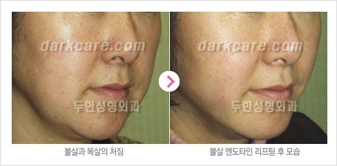 [두한성형외과 경쟁력 주름성형] - [주름제거를 위한 리프팅] 관련 이미지 24