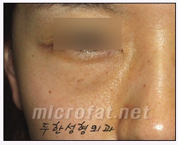 [두한성형외과 지방이식] - [다크서클, 눈밑주름] 관련 이미지 45