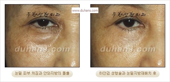 [두한성형외과 경쟁력 안검성형] - [젊어 보이면서 개선된 인상을 주기 위한 성형] 관련 이미지 34