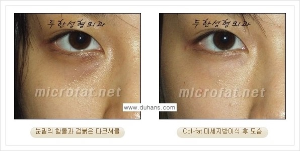 [두한성형외과 경쟁력 눈밑성형] - [눈밑 다크써클과 눈밑 함몰주름의 최적화 교정방법 안내] 관련 이미지 27