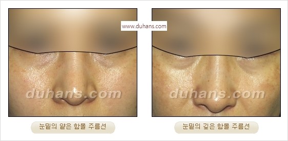 [두한성형외과 경쟁력 주름성형] - [간단하면서 자연스러운 주름제거 방법] 관련 이미지 3