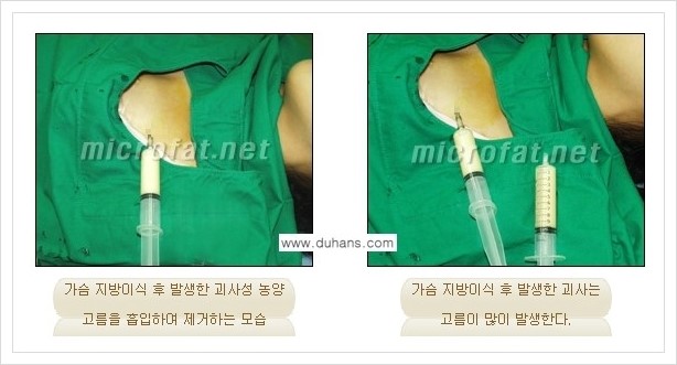[두한성형외과 경쟁력 미세지방이식] - [타병원에서의 미세지방이식 부작용 교정 방법 안내] 관련 이미지 4