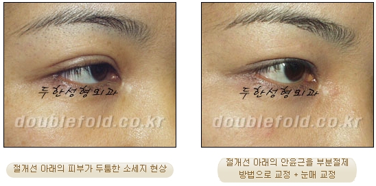 [Douhan Plastic Surgery Double Eyelid Revision] - [Correction of Uneven Eyes, Revision for Sausage Eyes, Ptosis Revision] image 10