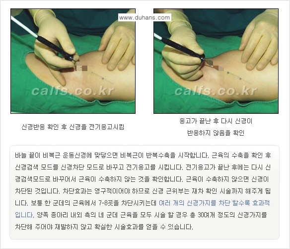 [두한성형외과 경쟁력 멀티종아리성형] - [종아리성형 방법별 전후 주의사항] 관련 이미지 11