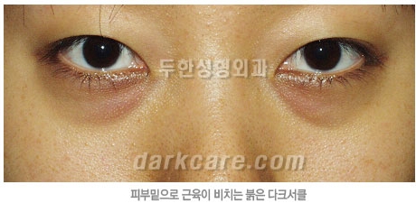 Duhan Plastic Surgery Dark Circle Improvement - What Causes Dark Circles? What Types of Dark Circles Are There? image 20