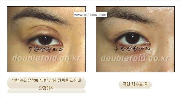 [두한성형외과 경쟁력 쌍꺼풀 재수술, 극한 눈재수술] - [망가진 쌍꺼풀 라인을 교정하는 극한 재수술을  위한 계획] 관련 이미지 7