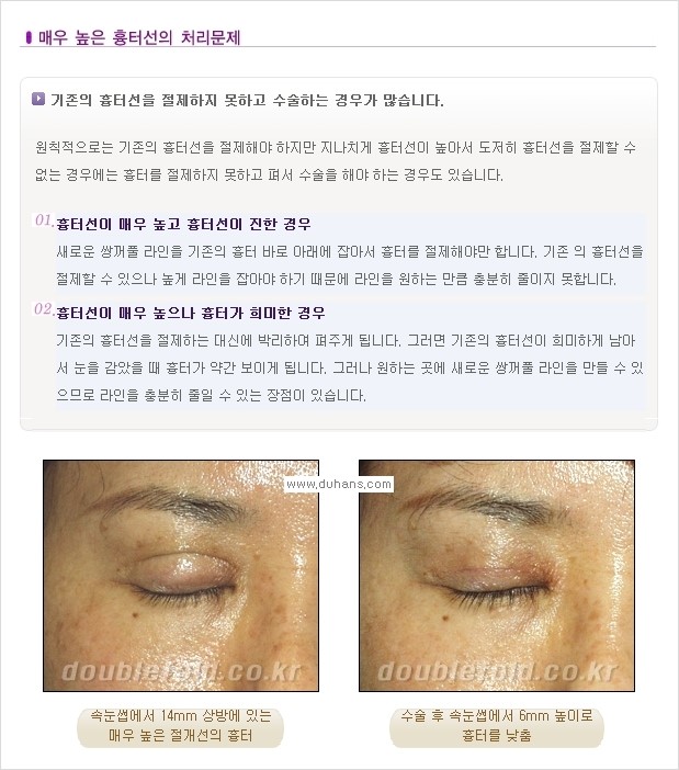 [두한성형외과 경쟁력 쌍꺼풀 재수술, 극한 재수술] - [쌍꺼풀 재수술, 극한 재수술 시 문제점 안내] 관련 이미지 1