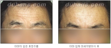 [두한성형외과 주름교정] - [지방이식을 이용한 주름개선] 관련 이미지 11