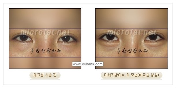 [두한성형외과 경쟁력 눈밑성형] - [애교살과 다크써클과의 관계] 관련 이미지 10