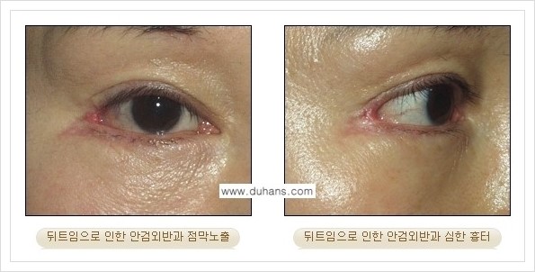 [두한성형외과 경쟁력 눈성형] - [앞트임 복원수술, 뒤트임 수술 안내] 관련 이미지 11
