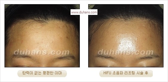 [두한성형외과 경쟁력 주름성형] - [간단하고 부작용 없는 자연스러운 주름제거 방법] 관련 이미지 38