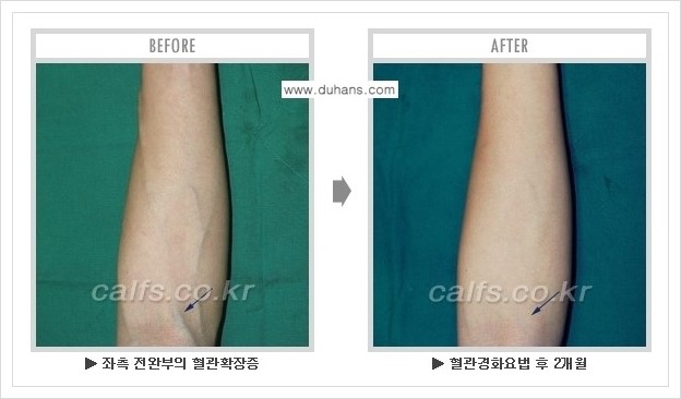 ⁠⁠[두한성형외과 정맥류 치료] - [손, 팔 정맥확장증 사진자료 안내 ②] 관련 이미지 10