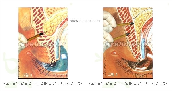 [두한성형외과 경쟁력 미세지방이식] - [꺼진(함몰된) 윗눈꺼풀 미세지방이식] 관련 이미지 3