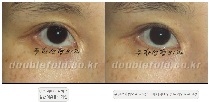 [Double Eyelid Surgery Duhan Plastic Surgery] - [Revision Methods] image 11