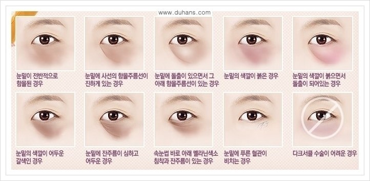 [두한성형외과 경쟁력 다크써클 교정] - [다양한 다크써클 증상 안내 3.] 관련 이미지 1