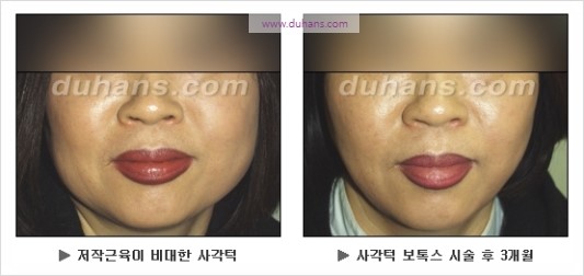 [두한성형외과 경쟁력 안면윤곽 성형 리더] - [완변한 V 라인! 턱 미세지방이식, 볼살 미세지방이식, 사각턱 보톡스 안내] 관련 이미지 38